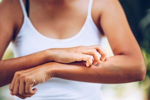 5 Myths About Seborrheic Dermatitis and How They're Holding You Back