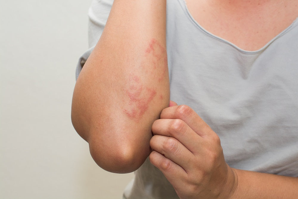 Contact Dermatitis- How to Identify & Manage