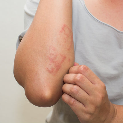 Contact Dermatitis- How to Identify & Manage