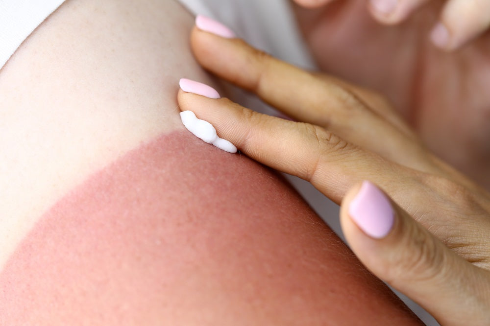 6 Mistakes to Avoid If You Have Dry Skin