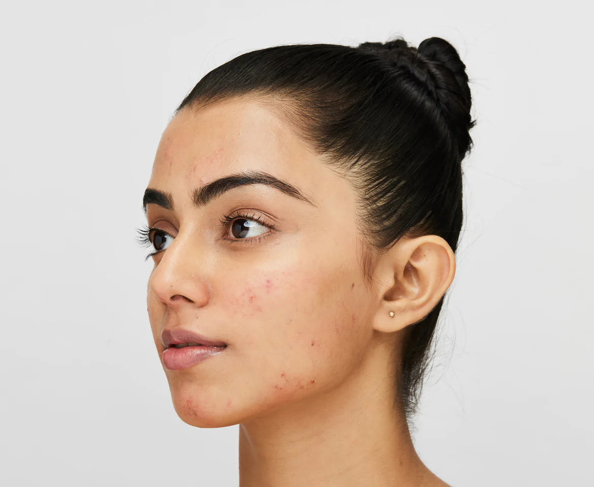 4 Stages of Acne & When to See an Expert