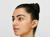 4 Stages of Acne & When to See an Expert