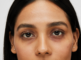 Is iron deficiency causing dark circles? Here’s how to fix it
