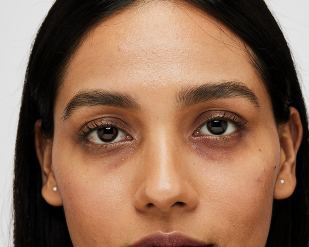 Is iron deficiency causing dark circles? Here’s how to fix it