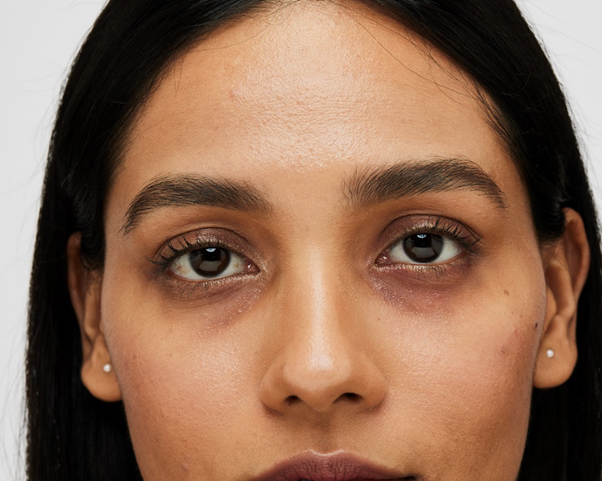Are your dark circles hereditary? Experts explain