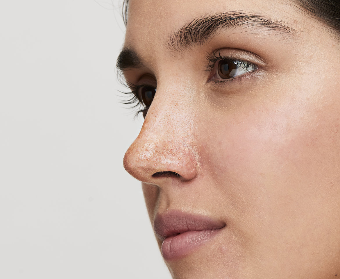 advanced approach to manage whiteheads
