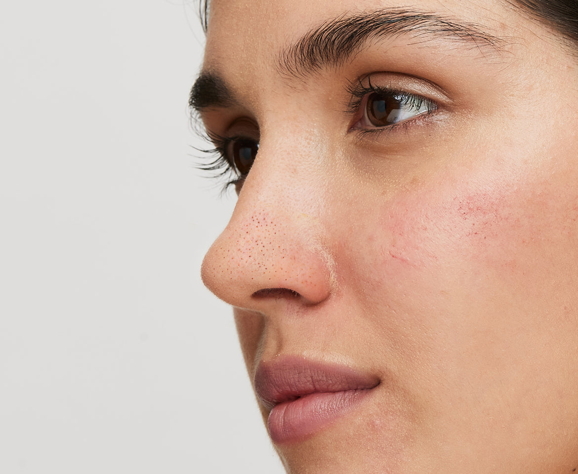 blackhead removal