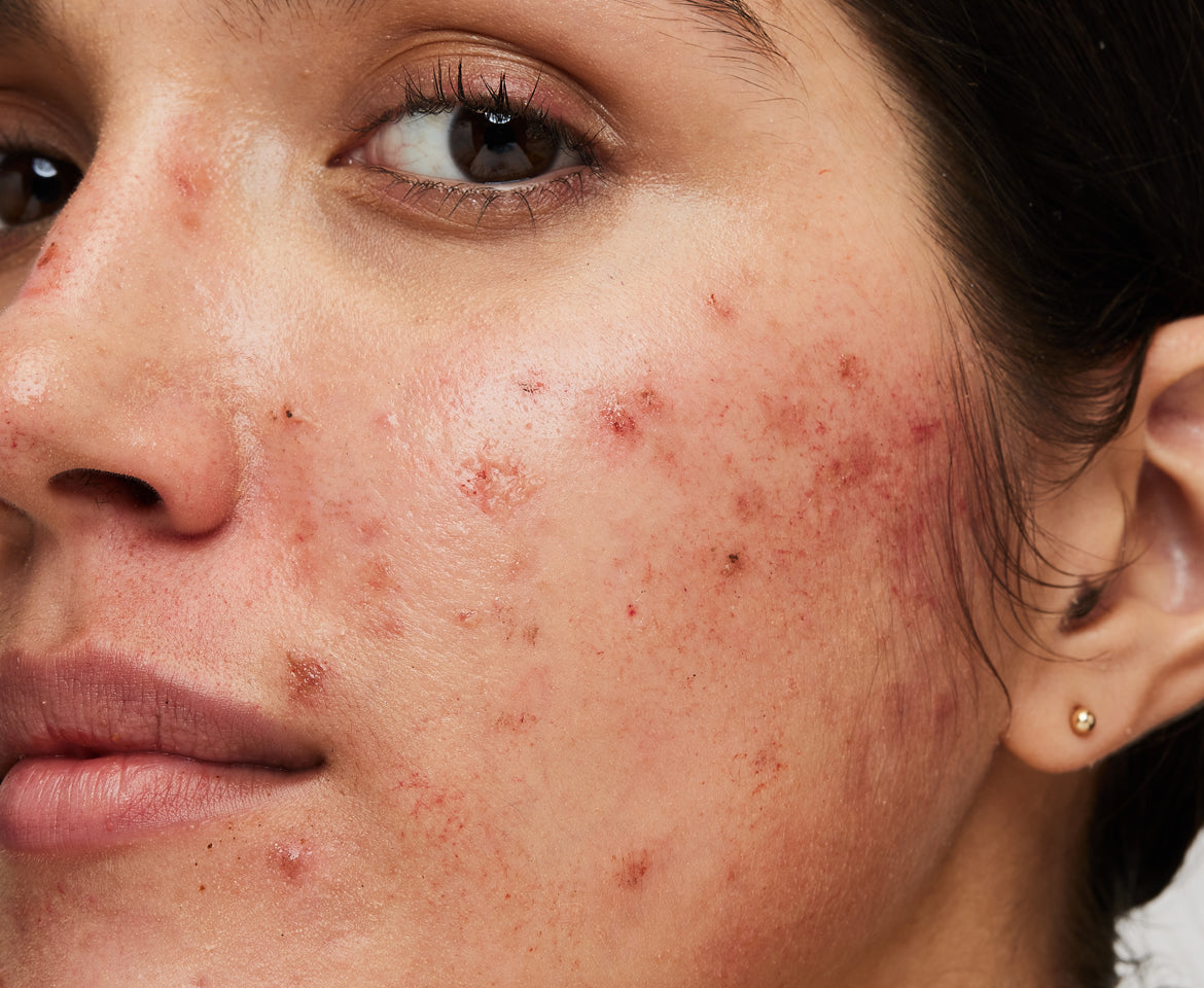 Repair Pigmented skin with the Latest Triple Formulation