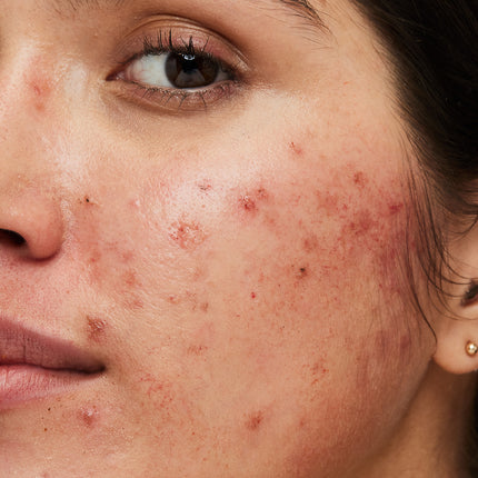 Here’s How a High Science Blend Can Help Heal Your PIH and Amplify Your Skin Tone#Pigmented Skin? Repair It with the Latest Triple Formulation