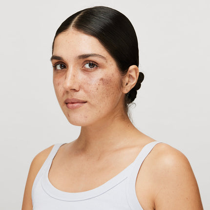 Freckles: When to Worry About Them?#Freckles Appearing Suddenly on the Face? This Is When You Should Act