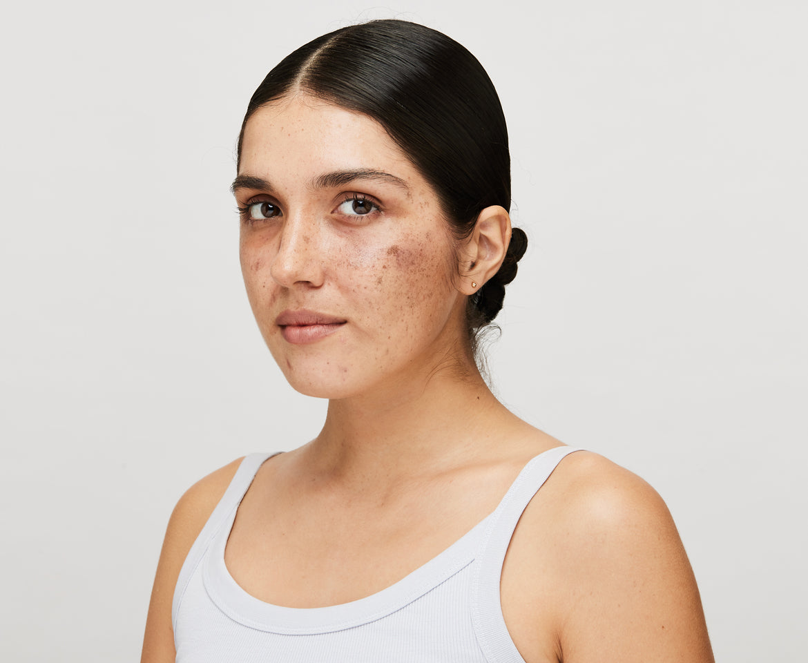 Treatment methods for Freckles on face