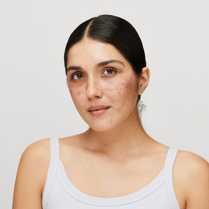 A Comprehensive Guide to Getting Rid of Pigmented Skin#Addressing All Problems Related to Hyperpigmentation