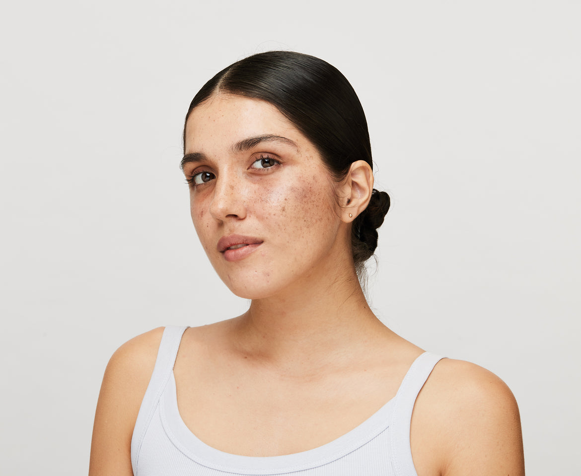 Identifying hyperpigmentation and reducing it with a holistic solution