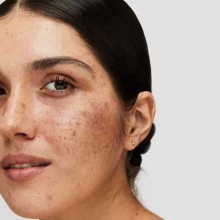 5 Scientifically Proven Ways to Reduce Melasma#Why Should You Choose High Science for Melasma?