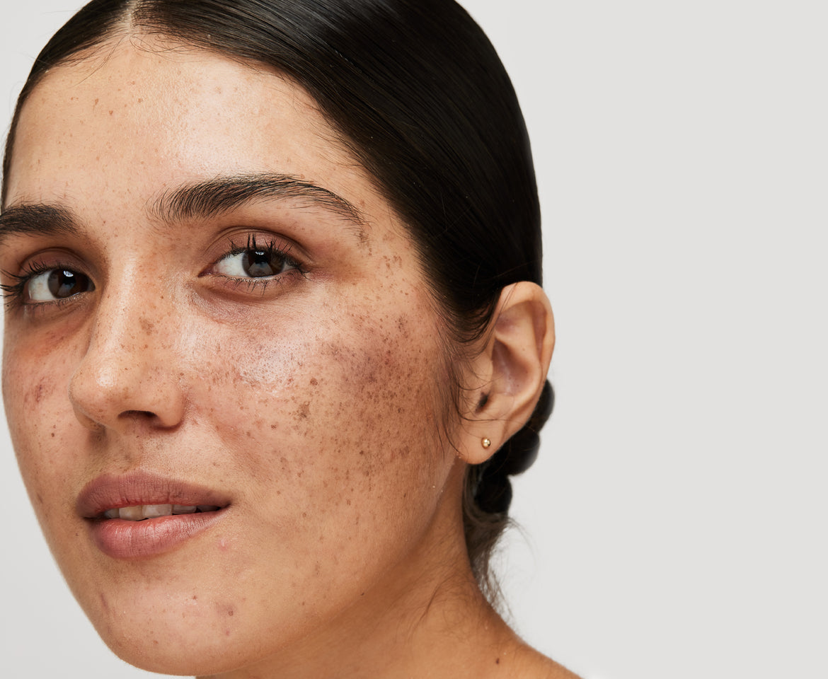 5 Scientifically Proven Ways to Reduce Melasma#Why Should You Choose High Science for Melasma?