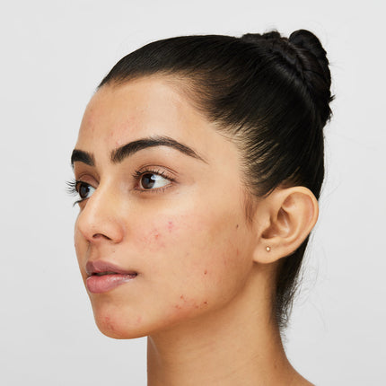Hormonal Acne: An Internal Affair#Battle your breakouts with thymol & terpineol