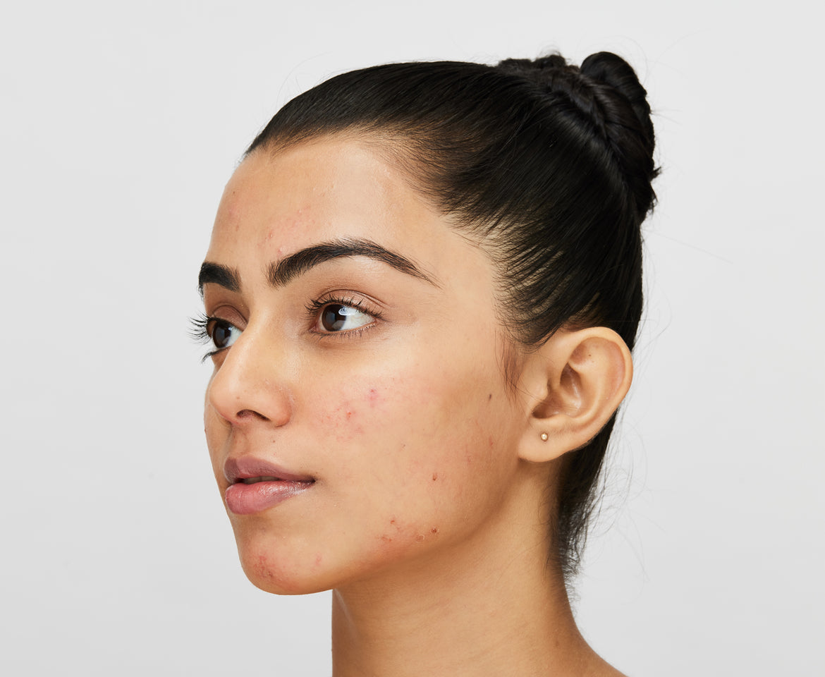 Hormonal acne scars
