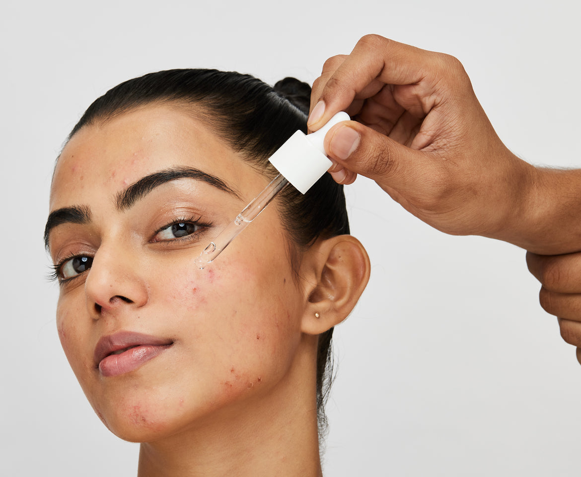 Skincare technology for genetic and hormonal acne 