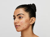 Recurring acne: Fight it with high-science solutions