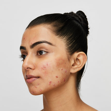 Recurring acne: Fight it with high-science solutions