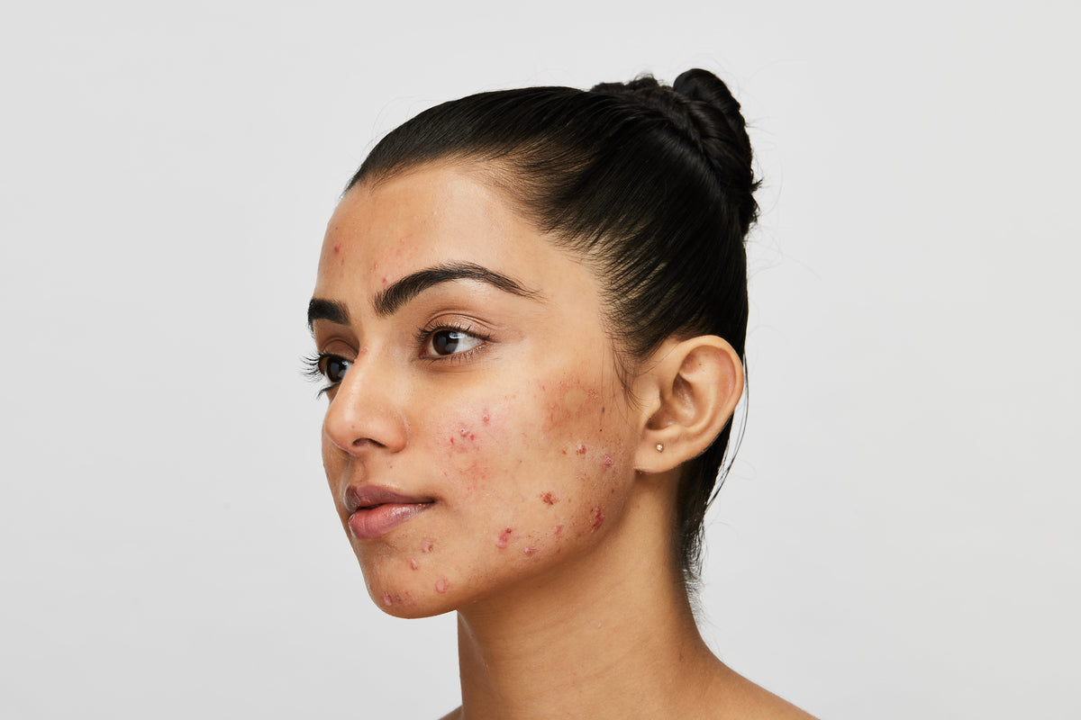 Recurring acne Fight it with high-science solutions