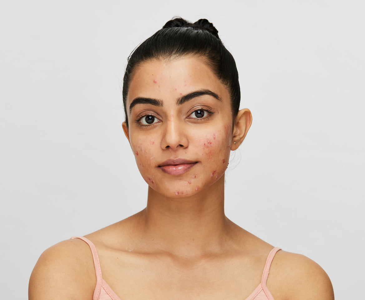 effects of acne on health  
