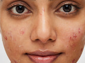 How Does Nodular Acne Differ from Cystic Acne?#Nodular acne v/s cystic acne