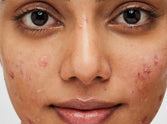 How Does Nodular Acne Differ from Cystic Acne?#Nodular acne v/s cystic acne
