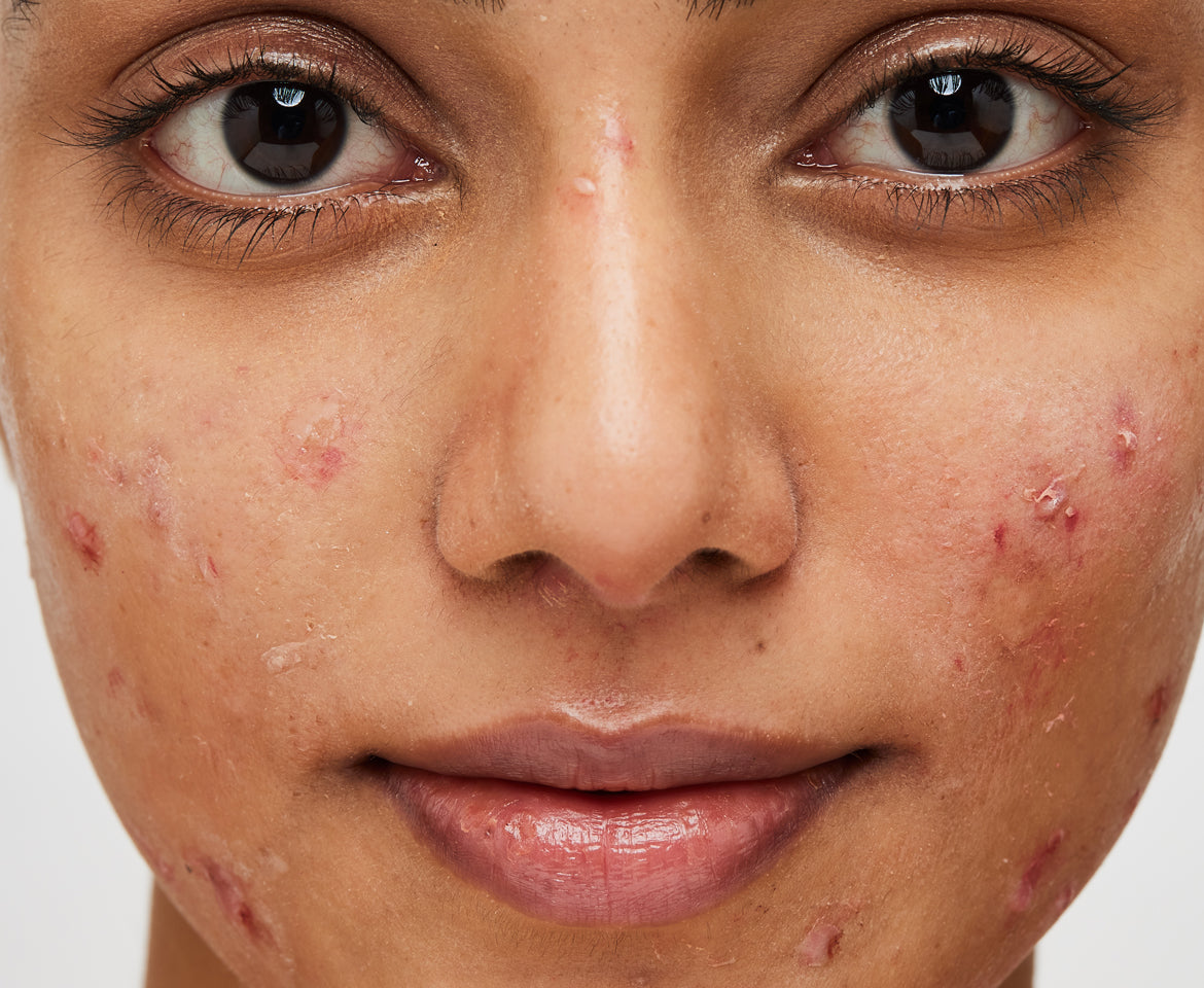 Lady having Nodular acne