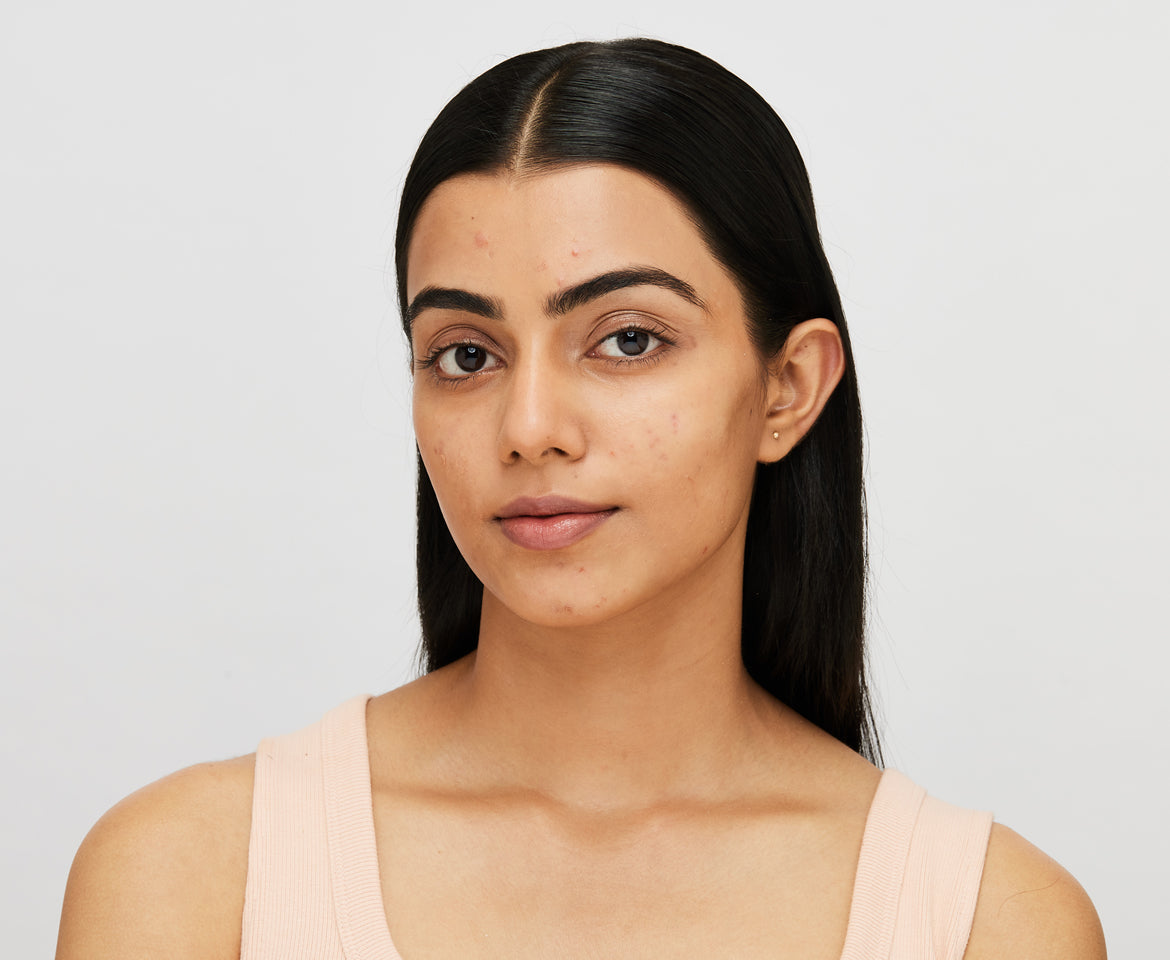 Say Goodbye to Your Cystic Acne