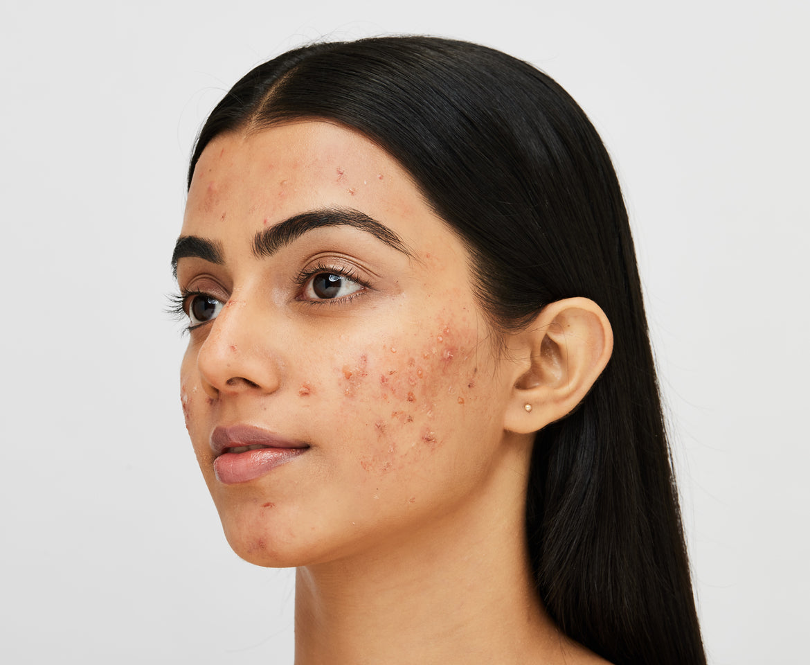 Salicylic acid may not be your all-in-one solution for Acne!# Salicylic Acid: Why you should avoid & what to use instead