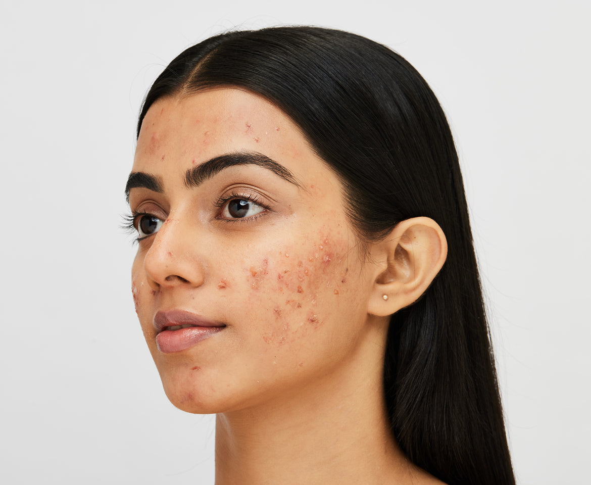 Salicylic acid for acne