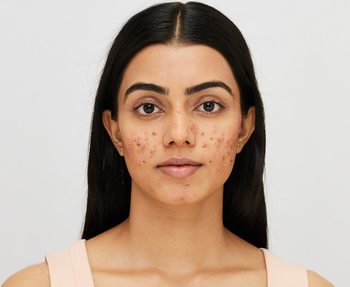 Papules troubles