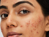 Lesser-Known Causes of Acne#5 surprising triggers of acne