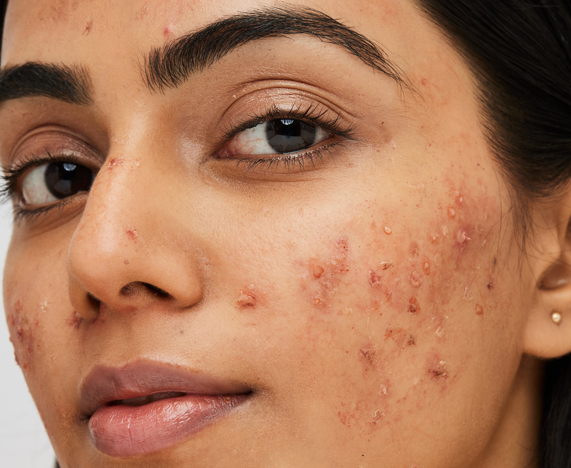 Triggers of acne