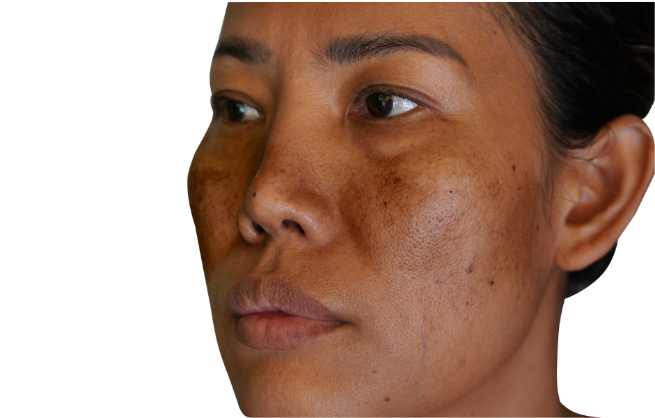 Why Winter Makes Your Pigmentation Worse (And How to Fix It)