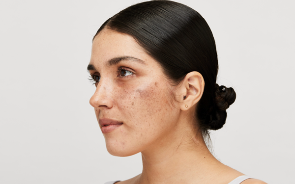 Is lack of Vitamin D causing skin pigmentation? Let’s find out
