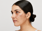 Is lack of Vitamin D causing skin pigmentation? Let’s find out