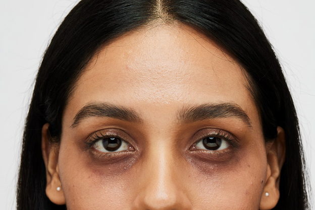 The truth about dark circles: 5 myths dispelled