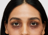 The truth about dark circles: 5 myths dispelled
