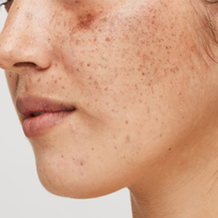 How the Environment You Live In Affects Skin Pigmentation#Environmental Pollutants & Hyperpigmentation: What’s the Link?