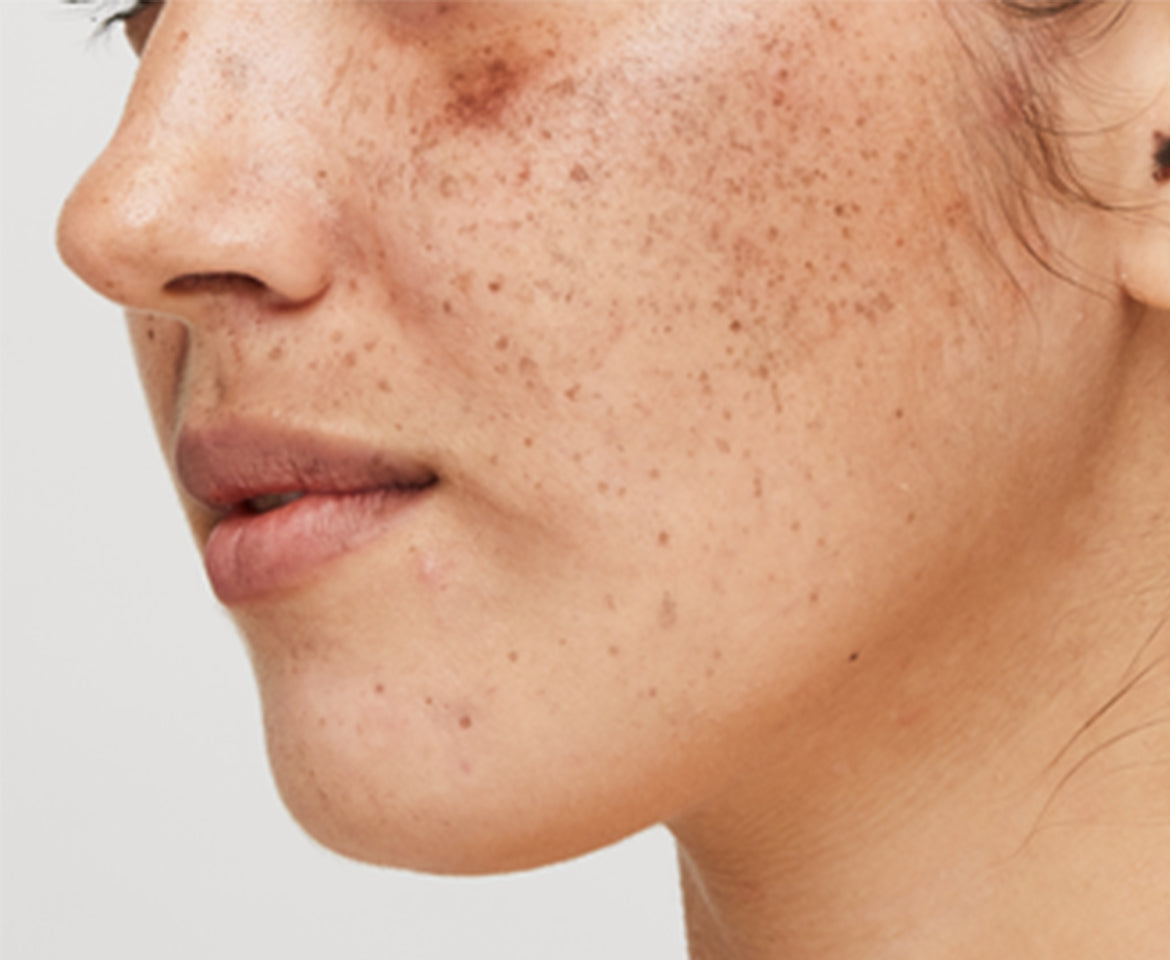 Environmental Pollutants & Hyperpigmentation