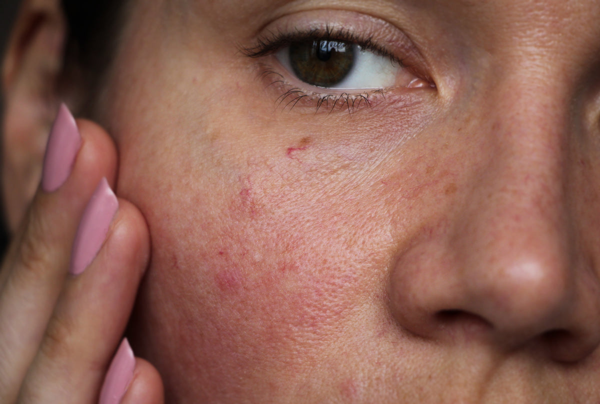 Protect sensitive skin with hypoallergenic skincare! Here’s how