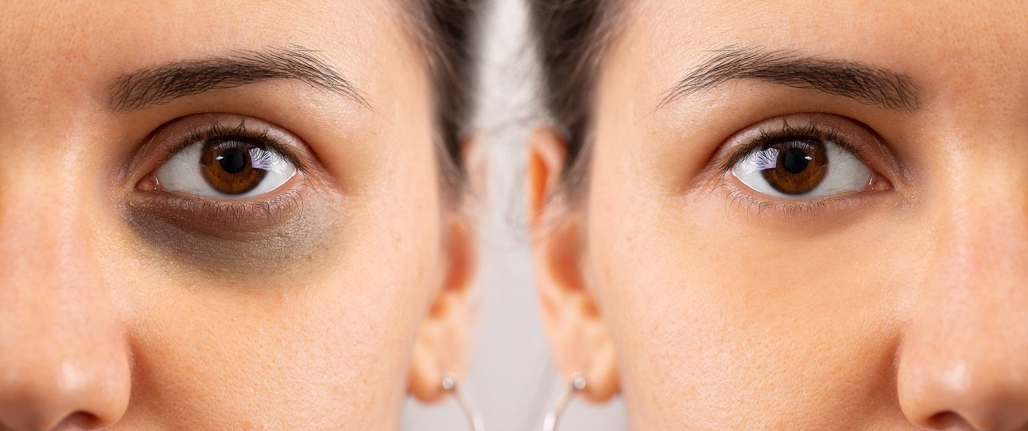 How to reduce dark circles, according to science