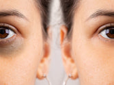 How to reduce dark circles, according to science