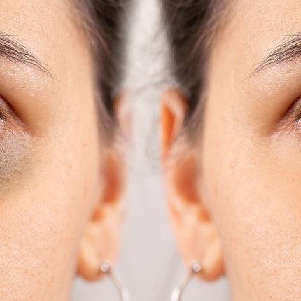 How to reduce dark circles, according to science