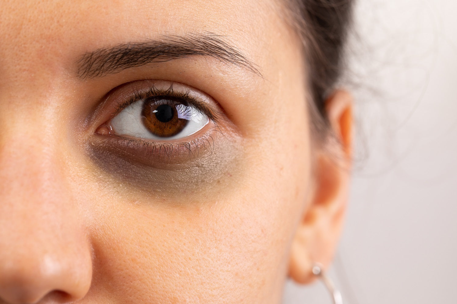 4 surprising reasons for dark circles & what you can do about them