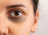 4 surprising reasons for dark circles & what you can do about them