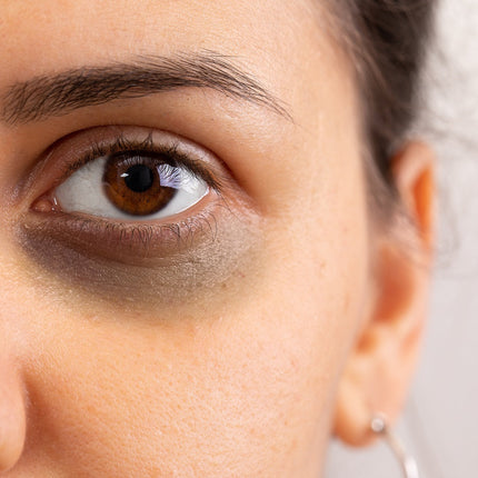 4 surprising reasons for dark circles & what you can do about them