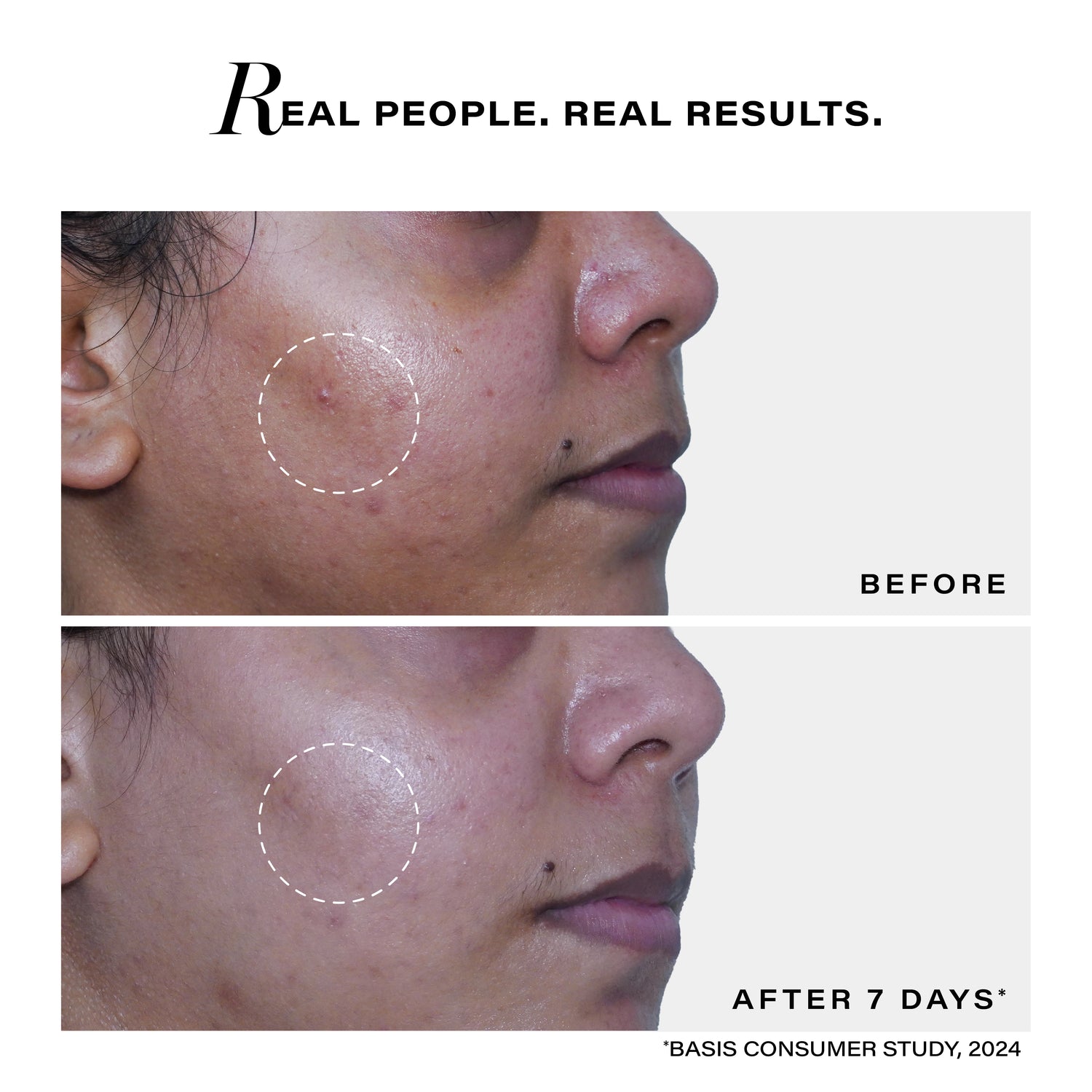 Acne Deep Clearing Cleanser
